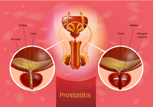 semne de prostatită la băieți radiation and hormone therapy for prostate cancer