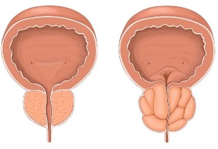 prevenirea și tratamentul prostatitei dureri de vezică urinară la bărbați