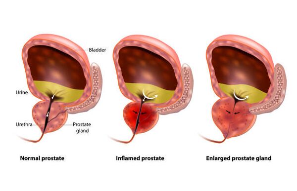 prostatita este o inflamație a prostatei