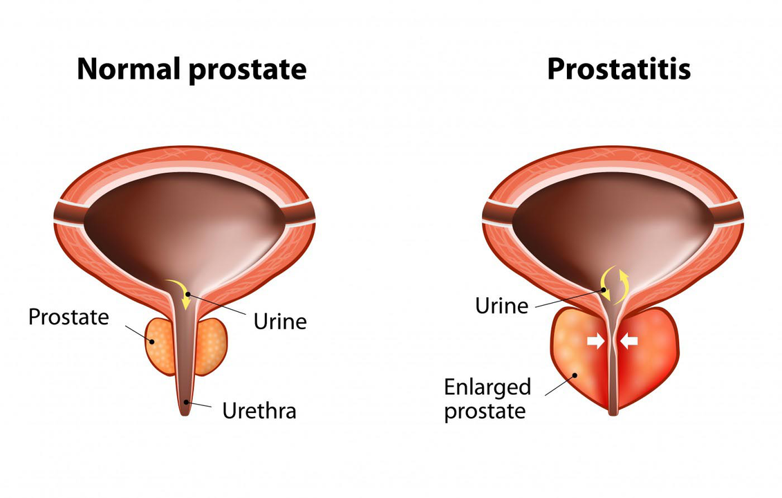 Prostată normală a unui bărbat sănătos și inflamația glandei prostatei cu prostatita